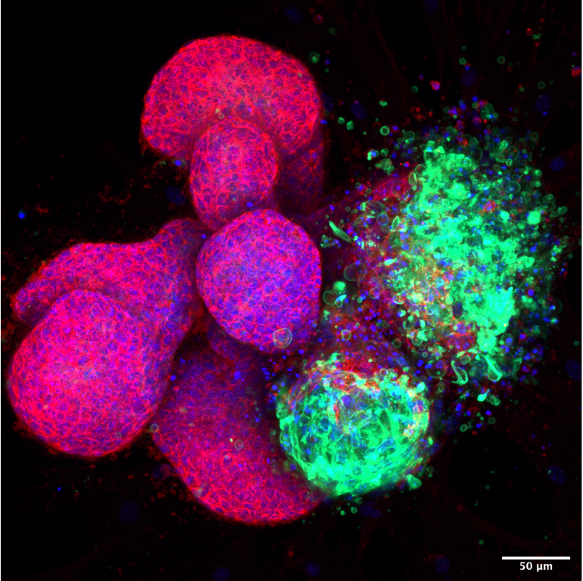 Normal (in red) and tumourigenic (in green) mammary (breast) epithelial cells growing ex vivo in 3D organoid culture
